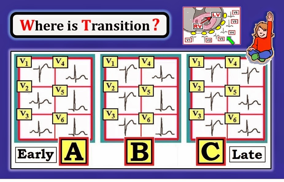 ECG Interpretation ECG Blog 94 (Basic Concepts7) QRST Changes