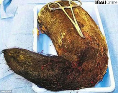 Retirada bola de cabelos de 2kg do intestino de indiana Retirada bola de cabelos de 2kg do intestino de indiana