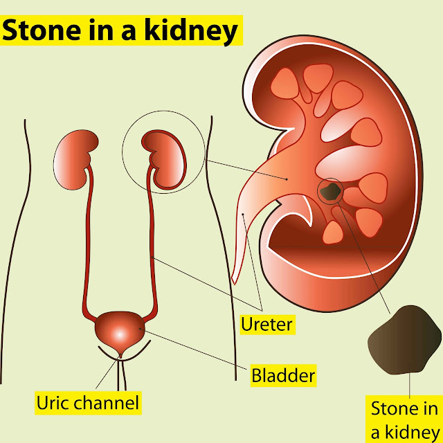 kidney stones home remedies kidney stones