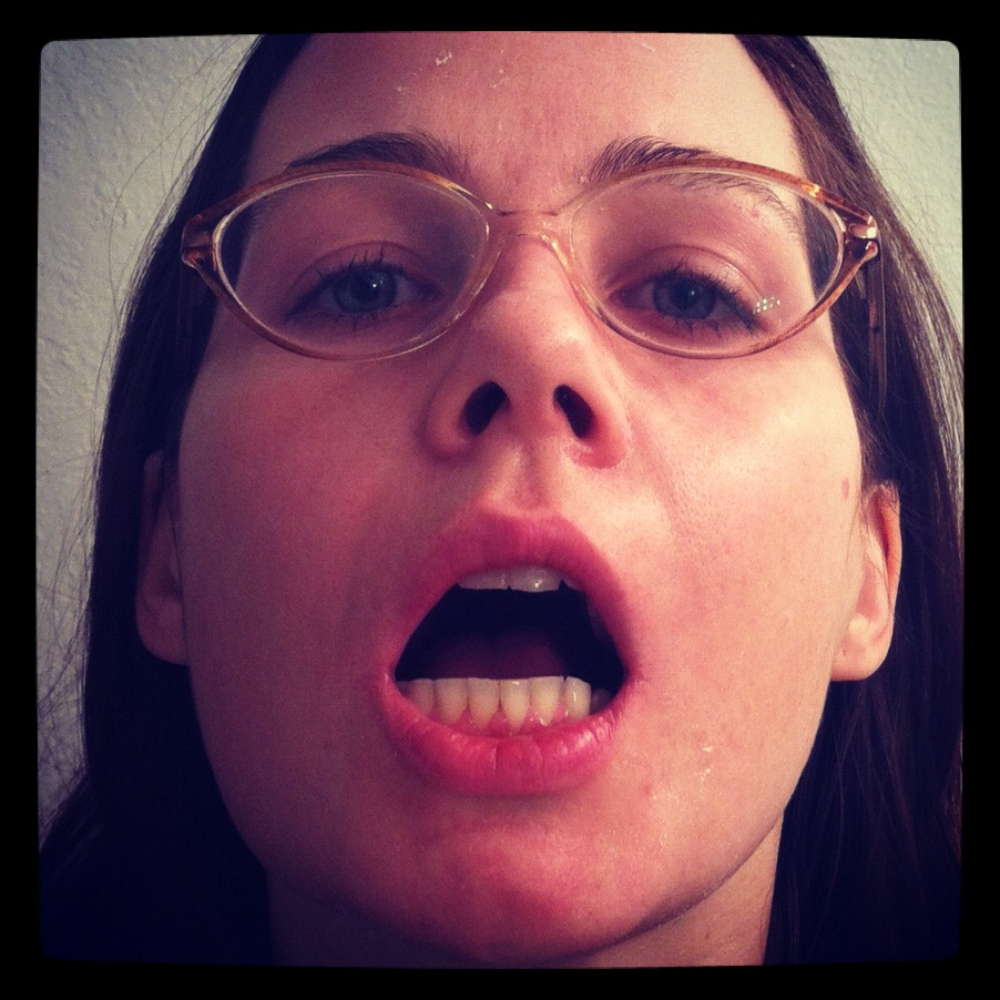 my crooked jaw pre/post