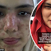 'Selepas seminggu, muka jadi bengkak' - Gadis kongsi pengalaman buruk jalani rawatan lazer