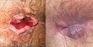 Foto Obat Salep Untuk Benjolan Disekitar Anus Lecet