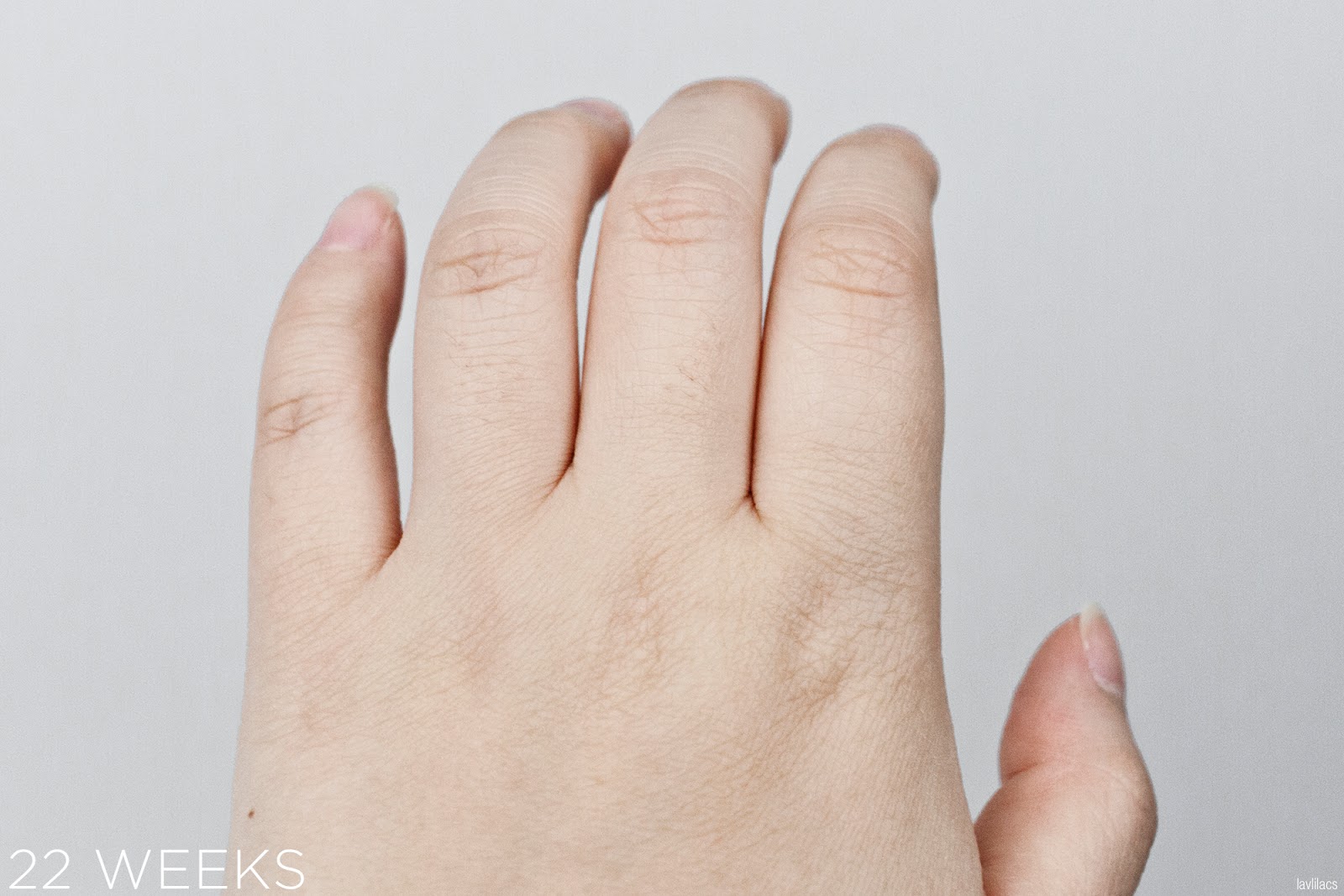 tria Hair Removal Laser Knuckle Hair 22 Weeks, 5 months