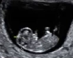 11 haftalık gebelik ultrason görüntüleri