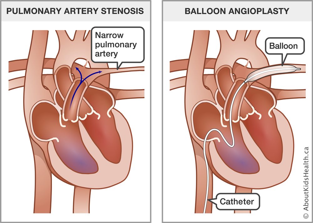 Heart Catheterization and Balloon Angioplasty for Kids with Extreme CHD