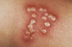 CARA CEPAT MENGOBATI EKSIM BASAH DI SELANGKANGAN DENGAN SALEP