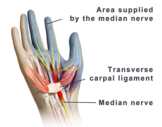 Pinched nerve