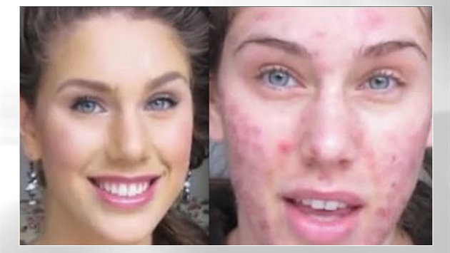 Online Accutane No Prescription