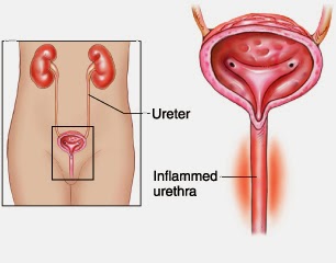 Urethritis - মূত্রনালীর প্রদাহ বা ইউরেথ্রাইটিস