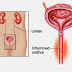 Urethritis - মূত্রনালীর প্রদাহ বা ইউরেথ্রাইটিস