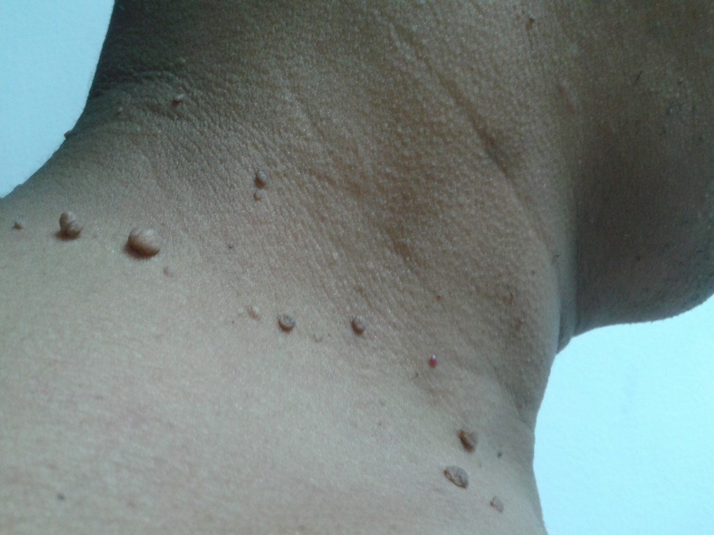 anillo de oscurecimiento alrededor del cuello diabetes
