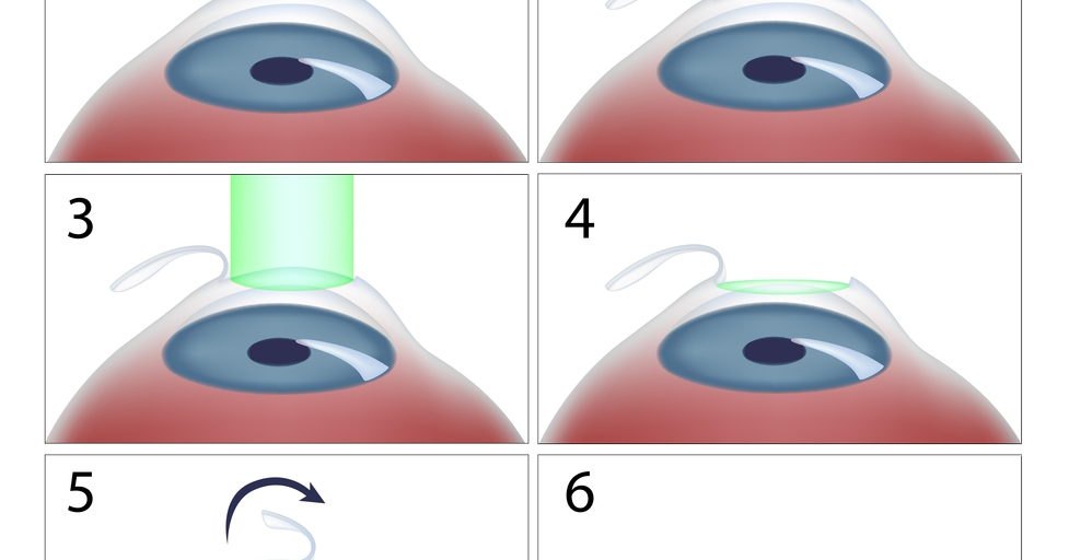 Повторная коррекция зрения ласик. Средства для коррекции зрения виды. Коррекция фрк ласик. Повторная коррекция зрения ласик. Настройки часов ласик.