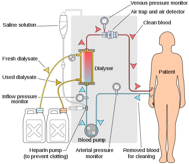 HOW DOES DIALYSIS WORK FOR KIDNEY FAILURE visual data 8