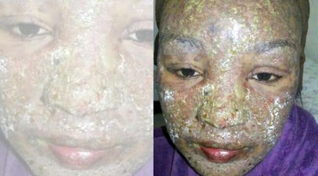 Ngeri ! Akibat Alergi Obat, Seorang Ibu Wajahnya Membusuk Ngeri ! Akibat Alergi Obat, Seorang Ibu Wajahnya Membusuk