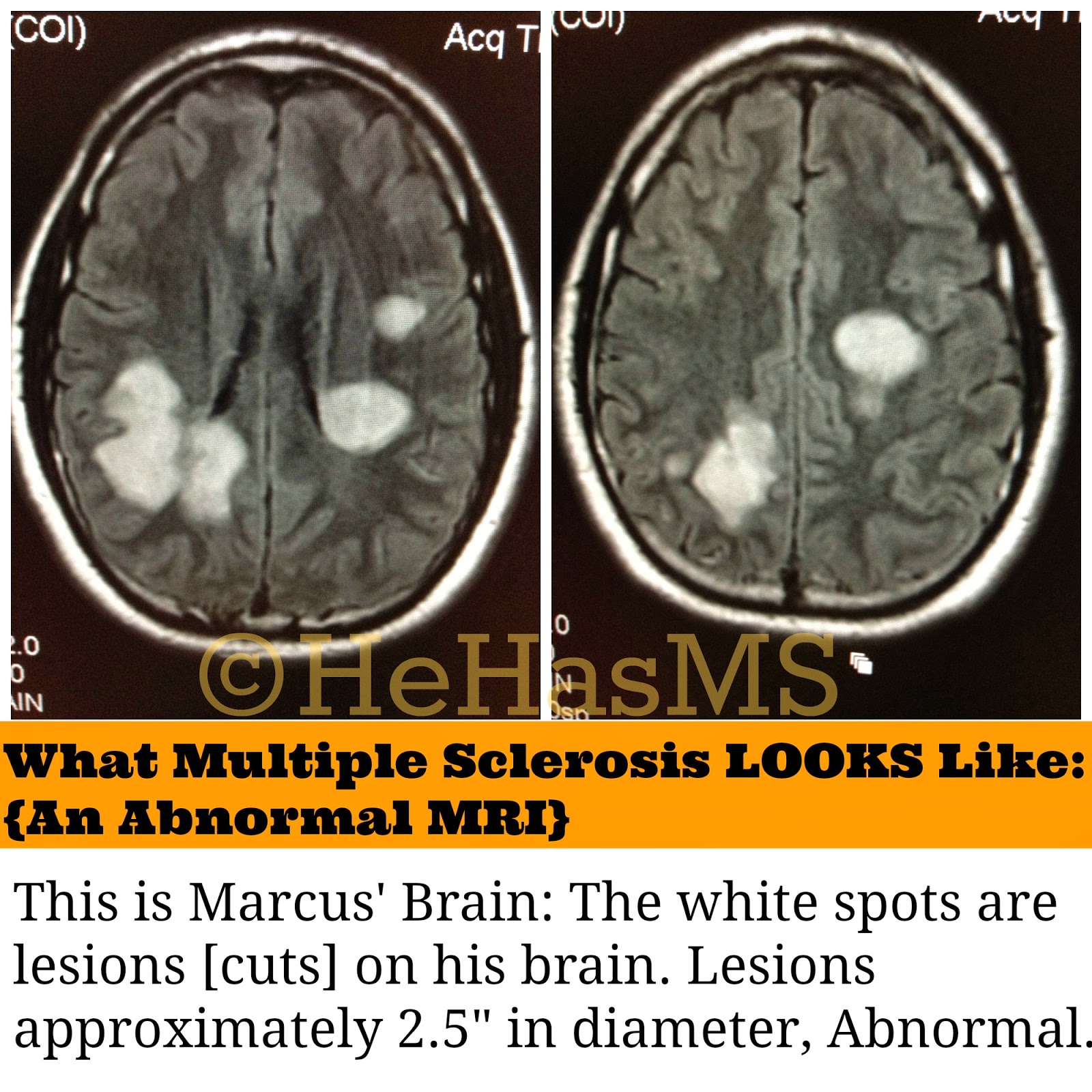 Brain Lesions Can You Feel Brain Lesions