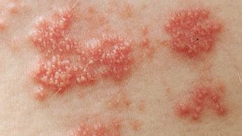 Penyakit Herpes Pada Kelamin