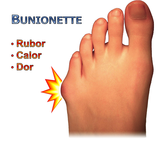 calçados adequados para joanete