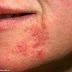 Pimple and Acne Near Lips Treatment by Home Remedies