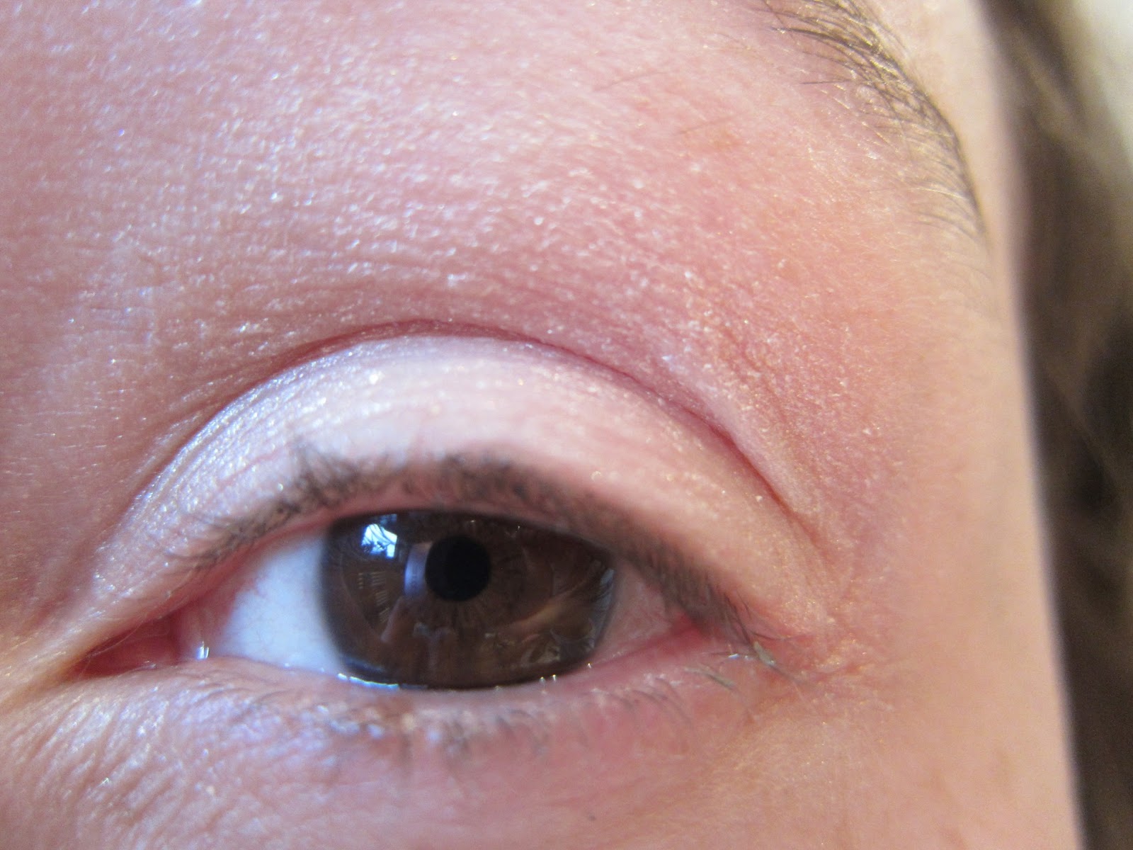 Petit Bouton Blanc Au Ras Des Cils Inférieur