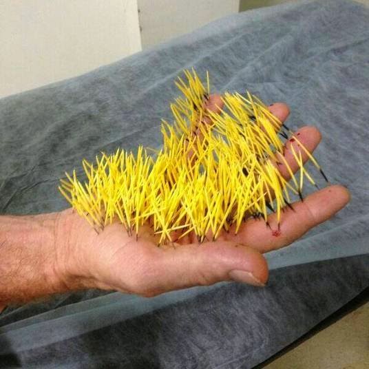 Brasileiro tem mais de 200 espinhos na mão após bater num ouriço