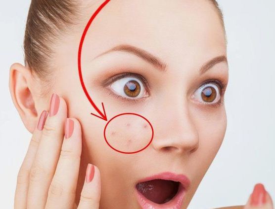 Great Natural Acne Remedies You Can Use for Your Face and Body