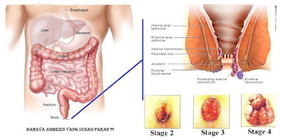 Foto Nama Obat Wasir Ambien Ekstrak Daun Ungu Yang Paling Laris