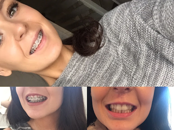 My experience with braces so far..
