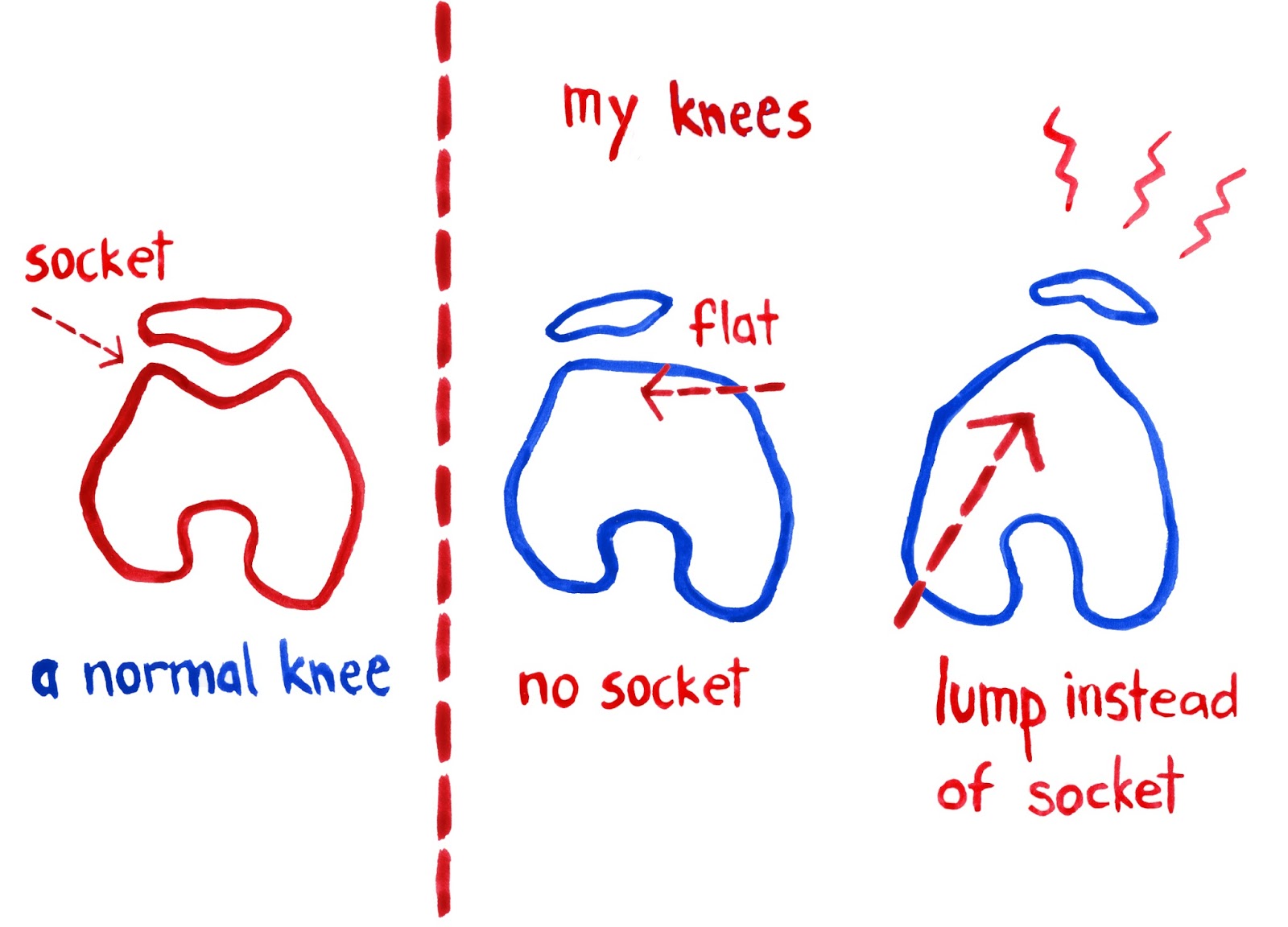 floating knees The Story of my Floating Knees The Update