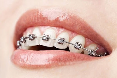 Giới thiệu các loại mắc cài tự đóng trong niềng răng