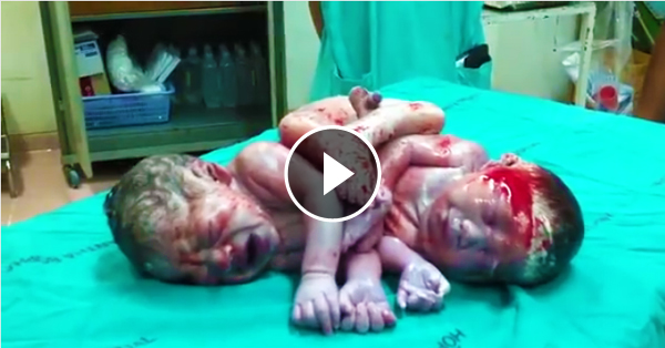 Conjoined twins giving oral
