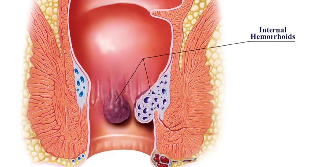 Voyeur rtp shy wife Hemmorhoids anus diagram photo