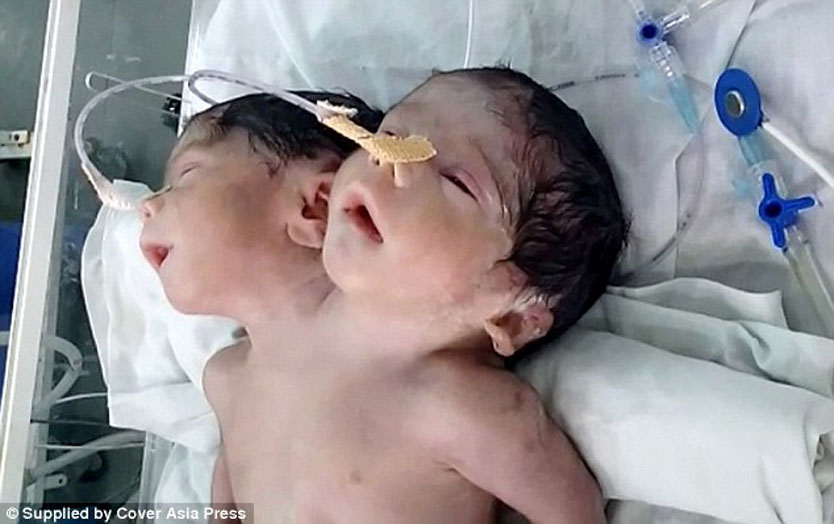 ‘Miracle’ baby boy born with two heads but only survives for 32 hours