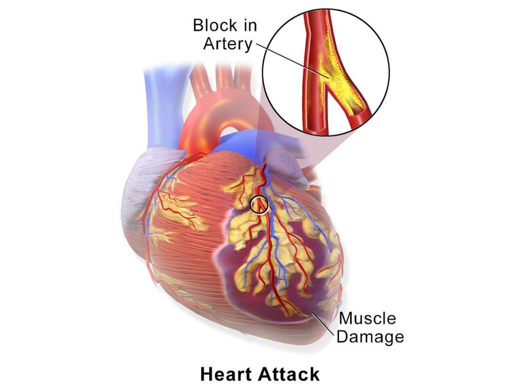 What is Angina? Symptoms, Causes, Prevention & Complications and Risk