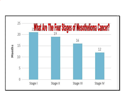 What Are The Four Stages of Mesothelioma Cancer?