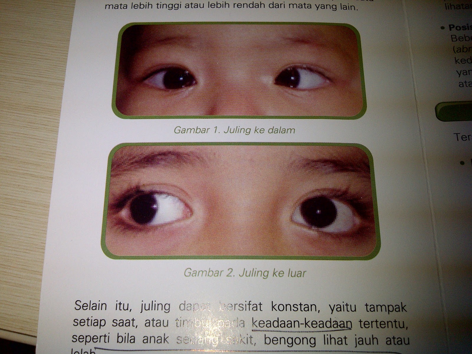 Me...and My Daily Life....: Strabismus dan Ambliopia (Lazy Eye) >> Part 1