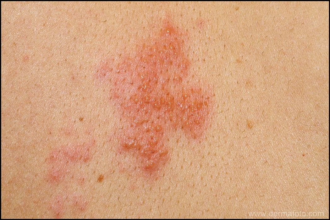 Herpes skin rash | General center | SteadyHealth.com