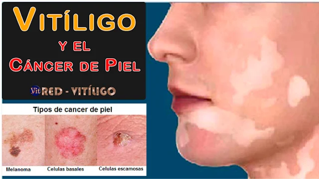 Vitiligo y el Cáncer de Piel