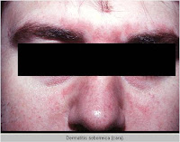 Dermatitis seborreica