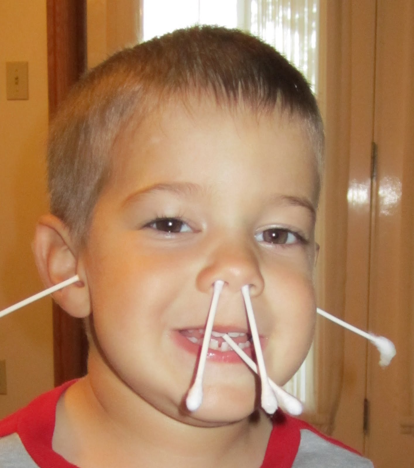 Congential Ptosis and Frontalis Sling Surgery 2011