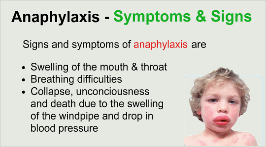 Symptoms And Signs Of Anaphylaxis Symptoms And Signs Of Anaphylaxis