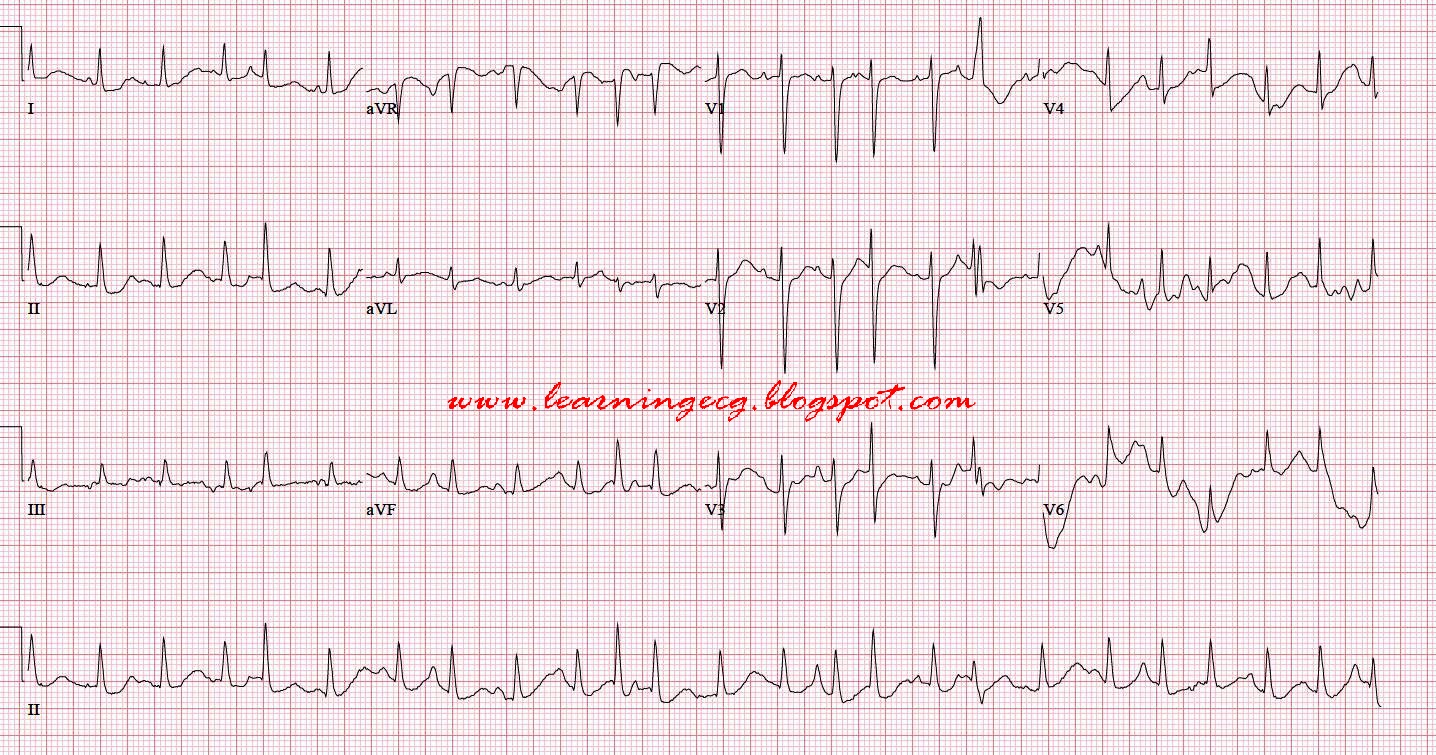 ECG Rhythms: Multifoca...