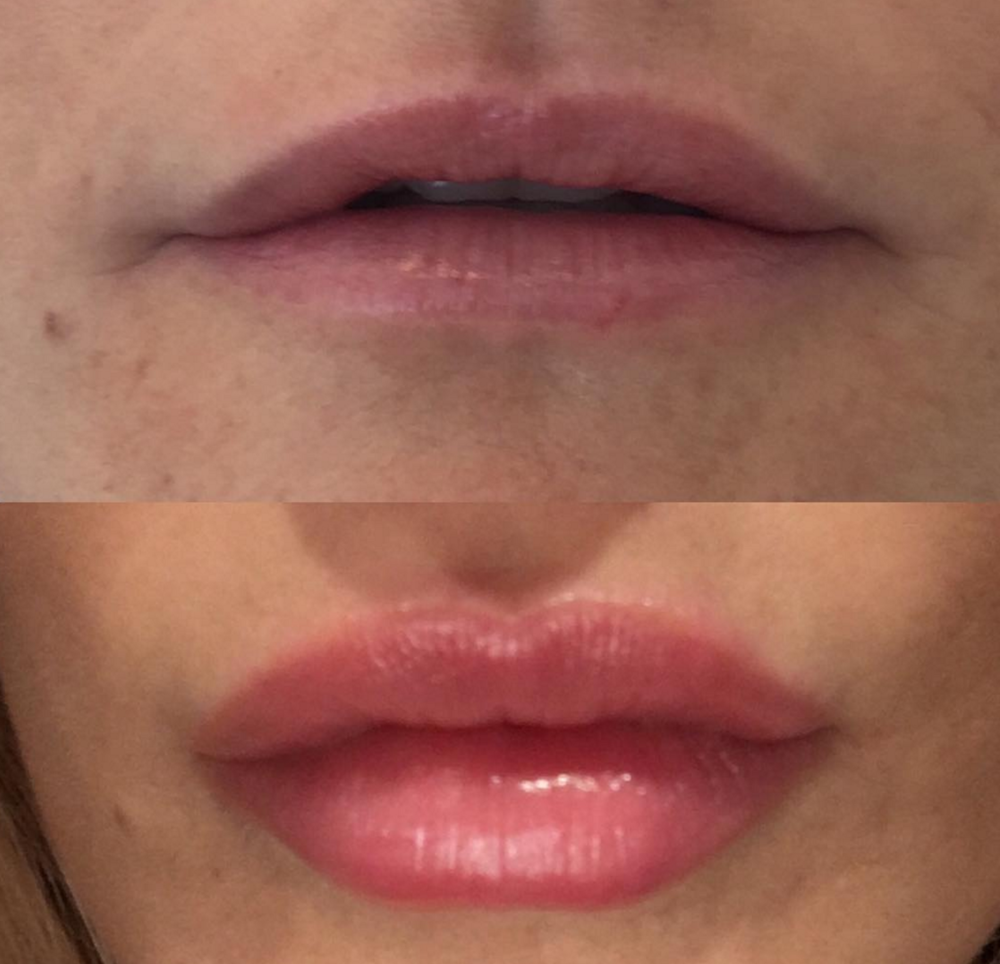 Lip Enhancement Bridgend