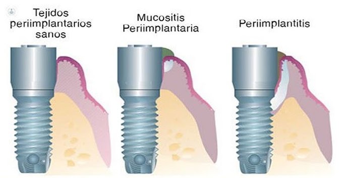 PERIIMPLANTITIS pone en riesgo la salud y supervivencia de los Implantes Dentales