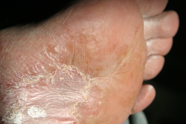 Obat Gatal Pada Telapak Tangan Dan Kaki Kulit Mengelupas obat gatal pada telapak tangan dan kaki kulit mengelupas