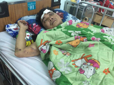 Nỗi ám ảnh của ca sĩ bị mất cánh tay sau tai nạn kinh hoàng - Ảnh 1 Noi am anh cua ca si bi mat canh tay sau tai nan kinh hoang - Anh 1