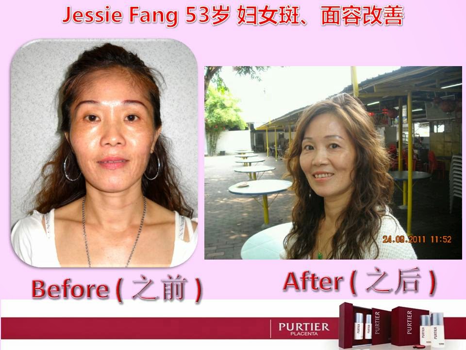 JESSIE FANG (53 YEARS OLD) FACE PIGMENTATION