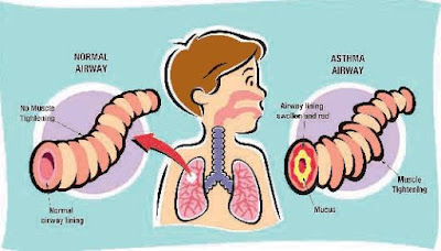  breathing problem asthuma wheezing homeo treatment in chennai