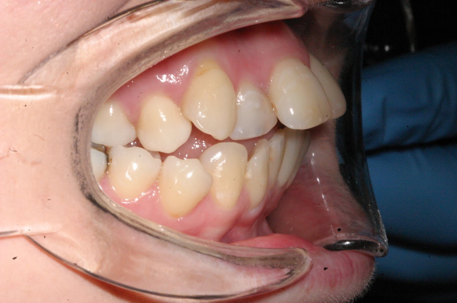 Braces SARPE SARME Surgery Spacers Part II The Profile Pics braces-sarpe-sarme-surgery-spacers-part-ii-the-profile-pics