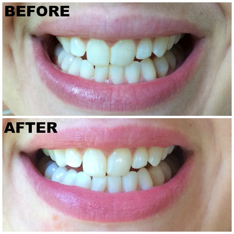 Real Girl's Realm The Easiest Way to Whiten Your Teeth at Home + a