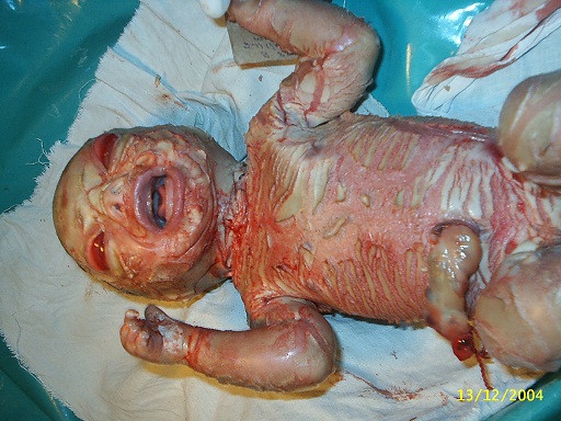 Newborn Skin: Part I. Common Rashes - American Family ...